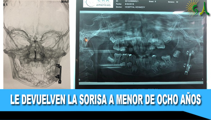 Complejo procedimiento maxilofacial le devuelve la sonrisa a niño de ocho años