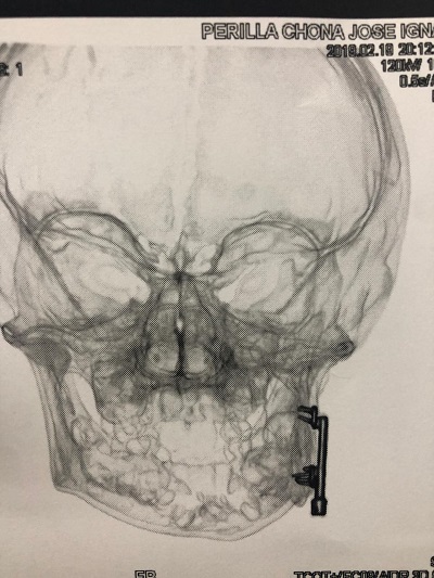 Complejo procedimiento maxilofacial le devuelve la sonrisa a niño de ocho años
