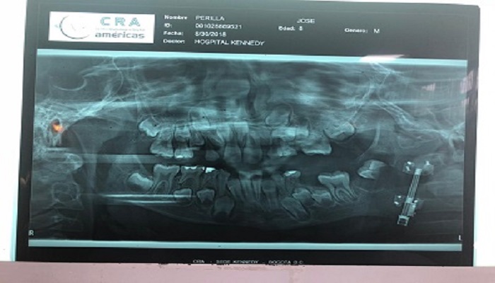 Complejo procedimiento maxilofacial le devuelve la sonrisa a niño de ocho años