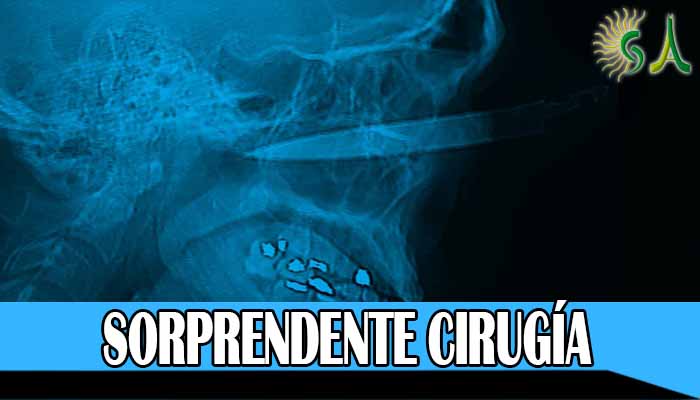 En sorprendente cirugía, médicos del hospital El Tunal retiran cuchillo del ojo de un hombre