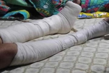 Mujer sufre fracturas en ambas piernas tras violento robo en Suba