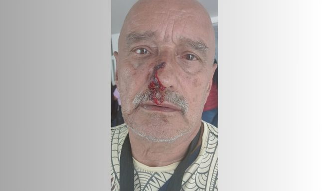 Residente de Lombardía herido por piedra mientras empresa de aseo podaba parque