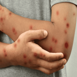 Bogotá confirma segundo caso de Mpox con variante de mayor transmisión y activa alerta en salud