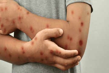 Bogotá confirma segundo caso de Mpox con variante de mayor transmisión y activa alerta en salud