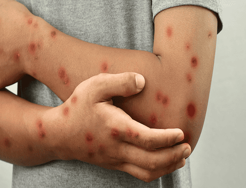 Bogotá confirma segundo caso de Mpox con variante de mayor transmisión y activa alerta en salud