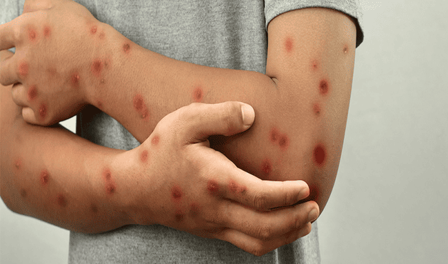 Bogotá confirma segundo caso de Mpox con variante de mayor transmisión y activa alerta en salud