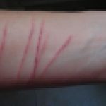 Alarma en Suba: madres denuncian presuntos casos de autolesiones entre estudiantes de colegio de la localidad